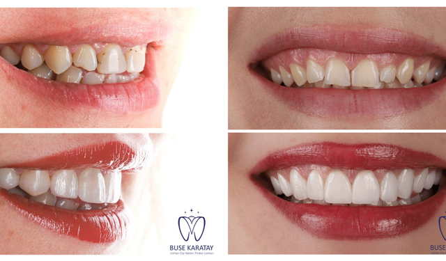 Porselen Diş uygulamaları güvenli mi?