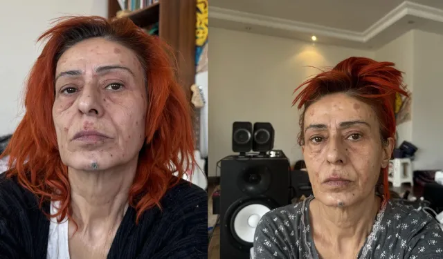 Yıldız Tilbe saçını boyarken yüzünü yakmıştı: Hayranı maske hediye etti